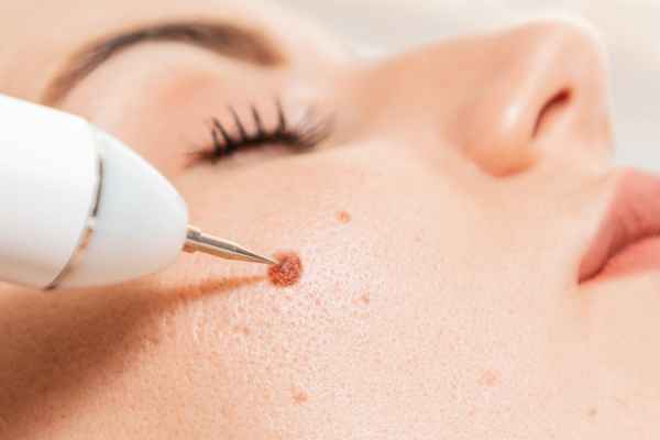 CryoPen: 5 Skin Concerns It May Be Used to Treat 3 What actually happens during a CryoPen treatment Little Paxton?