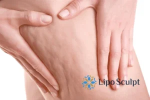 CoolSculpting for Legs: The Innovative Approach to Redefining Your Legs 5 Start your journey today book your coolsculpting treatment Little Paxton online today!
