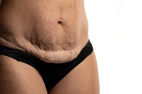 Lost the Weight but Not the Loose Skin? 1 image of womans stomach after weight loss showing loose skin Little Paxton