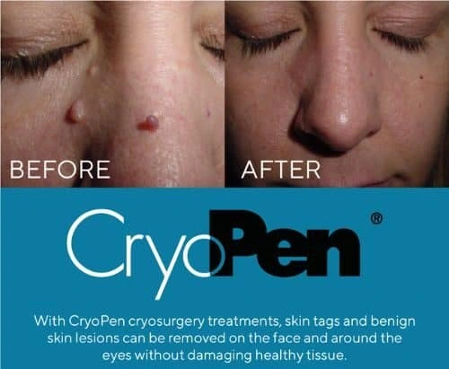 image of angiofibroma removal Little Paxton using Lipo Sculpt cryopen!